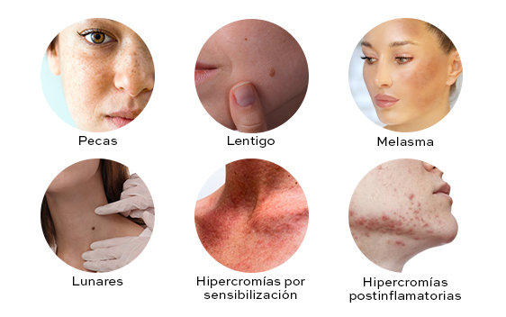 Diferentes tipos de manchas en la piel